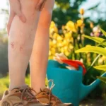 Mengobati Varises, Gangguan Pembuluh Darah yang Bisa Diatasi